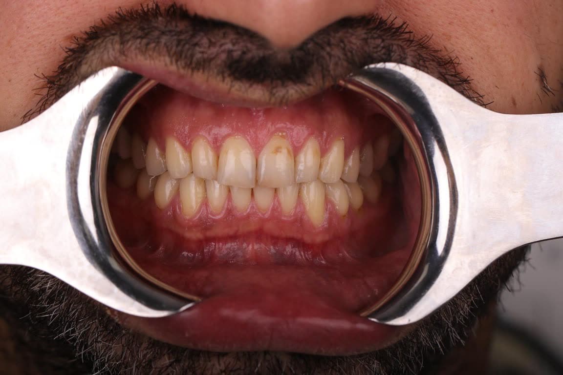שיניים לפני ציפוי — גוון טבעי